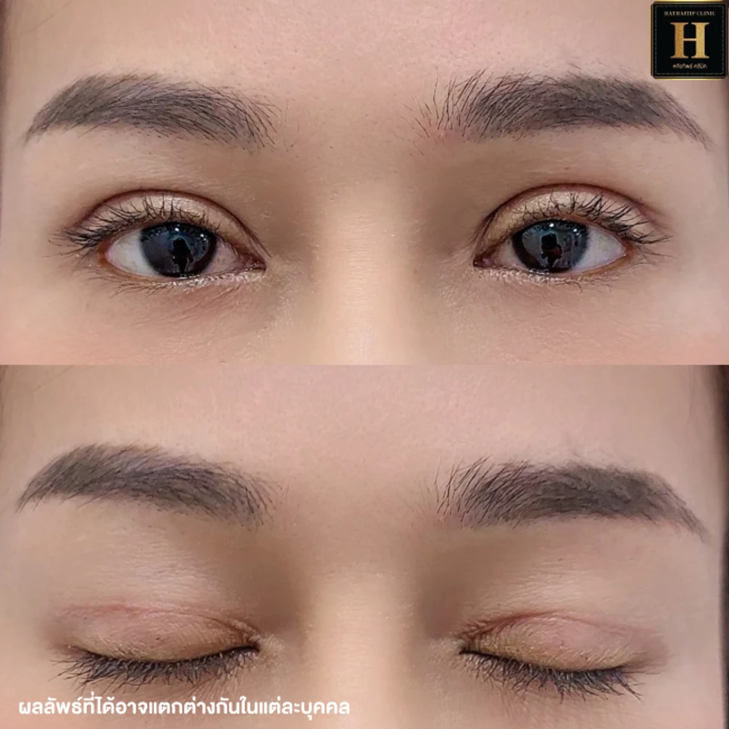 ทำตาสองชั้นแบบกรีดยาว พร้อมตัดไขมัน ตัดหนังตา และยกหางหงส์ สำหรับเคสทำครั้งแรกหรือเคสแก้