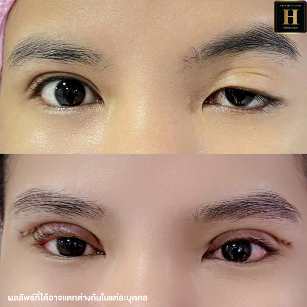 ทำตาสองชั้นแบบกรีดยาว พร้อมตัดไขมัน ตัดหนังตา และยกหางหงส์ สำหรับเคสทำครั้งแรกหรือเคสแก้