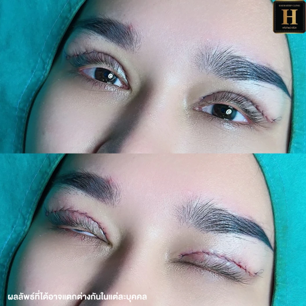 ทำตาสองชั้นแบบกรีดยาว พร้อมตัดไขมัน ตัดหนังตา และยกหางหงส์ สำหรับเคสทำครั้งแรกหรือเคสแก้