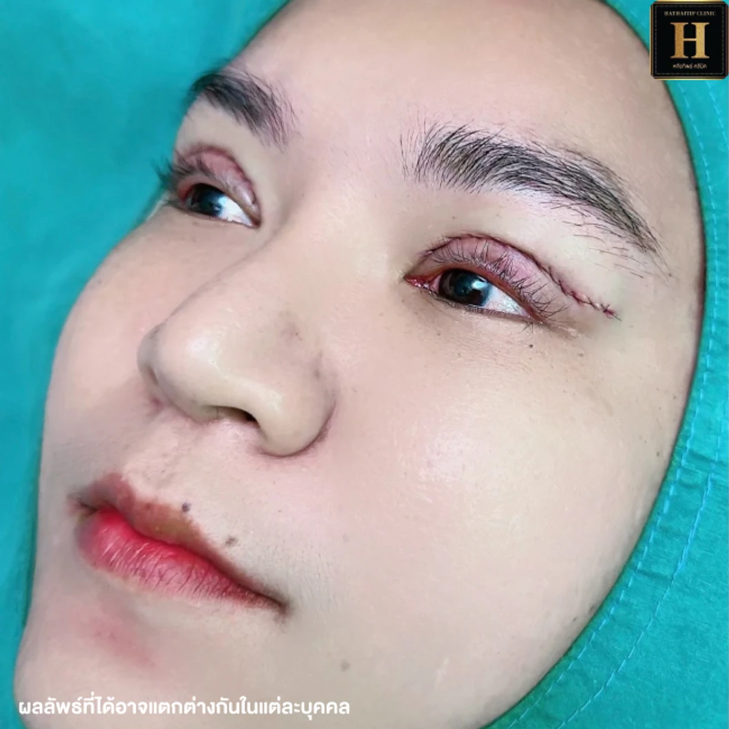 ทำตาสองชั้นแบบกรีดยาว พร้อมตัดไขมัน ตัดหนังตา และยกหางหงส์ สำหรับเคสทำครั้งแรกหรือเคสแก้