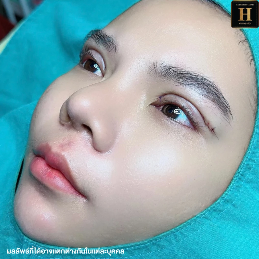 ทำตาสองชั้นแบบกรีดยาว พร้อมตัดไขมัน ตัดหนังตา และยกหางหงส์ สำหรับเคสทำครั้งแรกหรือเคสแก้