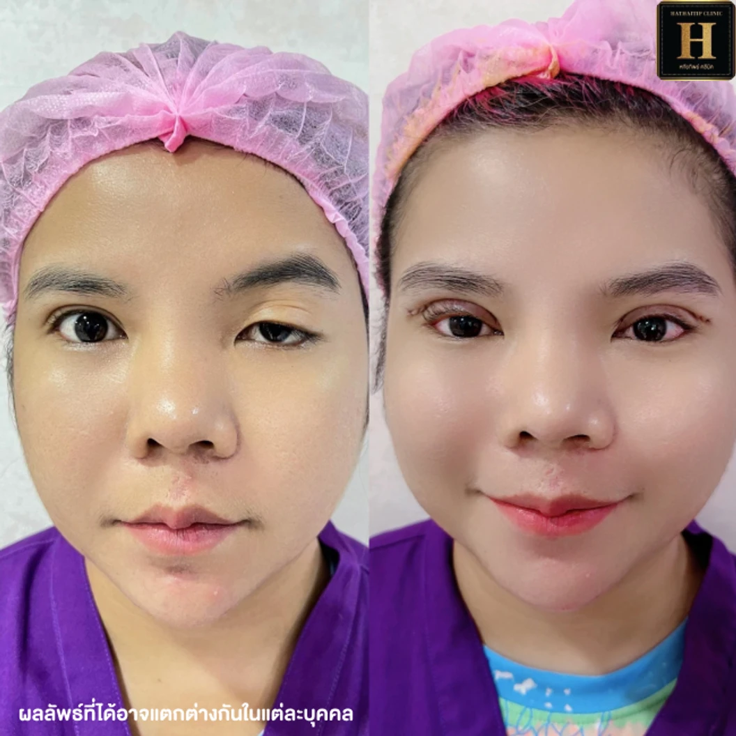 ทำตาสองชั้นแบบกรีดยาว พร้อมตัดไขมัน ตัดหนังตา และยกหางหงส์ สำหรับเคสทำครั้งแรกหรือเคสแก้