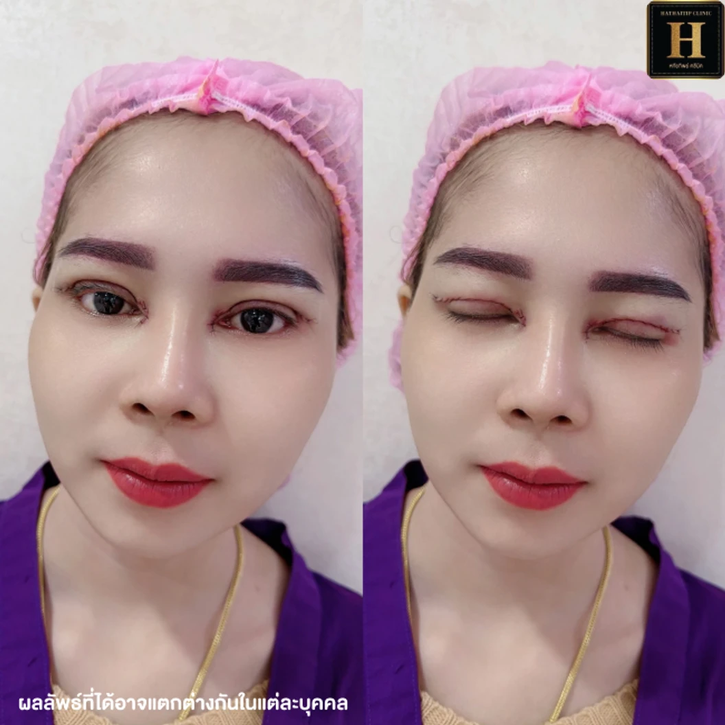 ทำตาสองชั้นแบบกรีดยาว พร้อมตัดไขมัน ตัดหนังตา และยกหางหงส์ สำหรับเคสทำครั้งแรกหรือเคสแก้