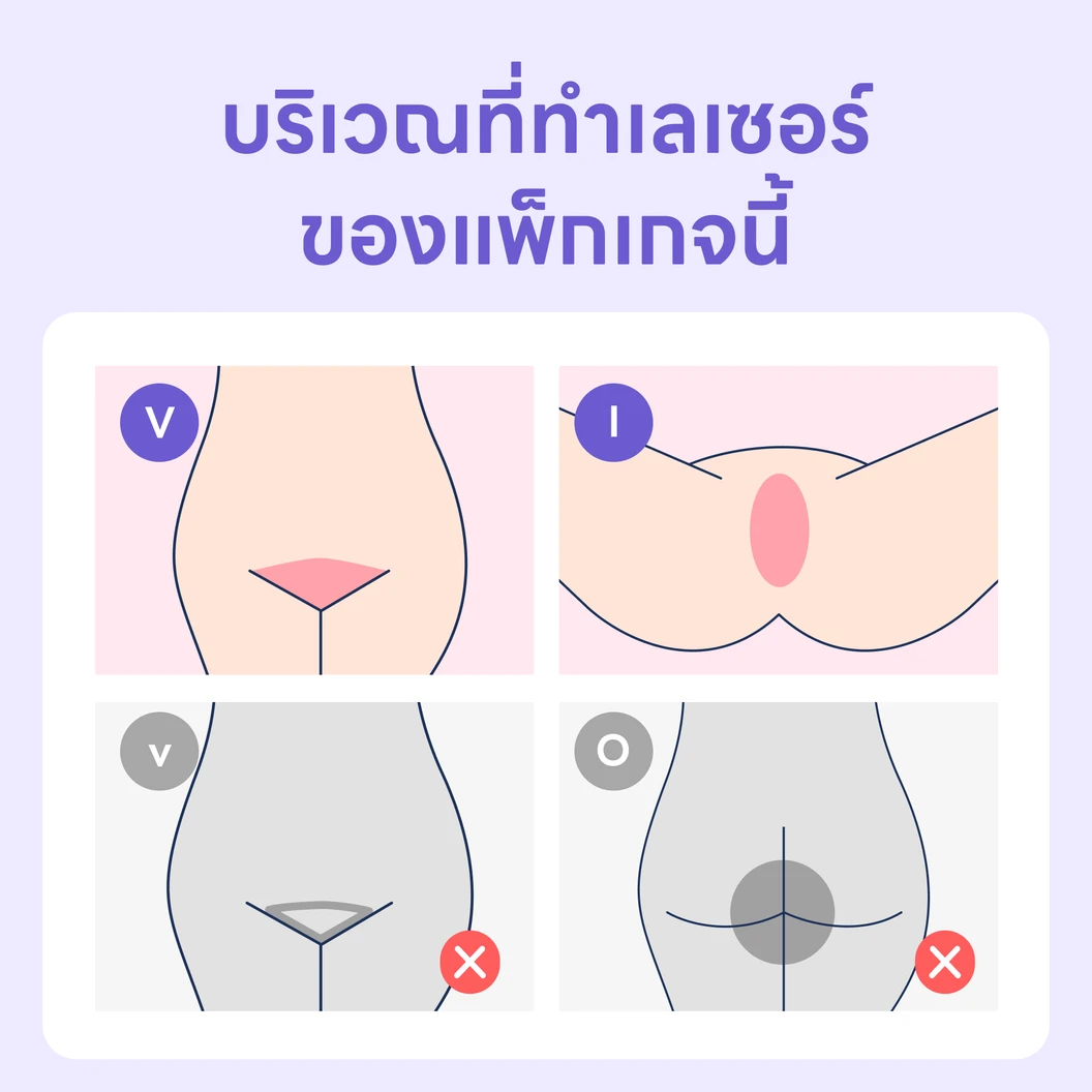 คอร์สกำจัดขน Brazilian ด้วย Cool Light Bolt หัว Trio​ 5 ครั้ง ภายใน 6 เดือน สำหรับผู้หญิงหรือผู้ชาย ที่ Sirin Clinic