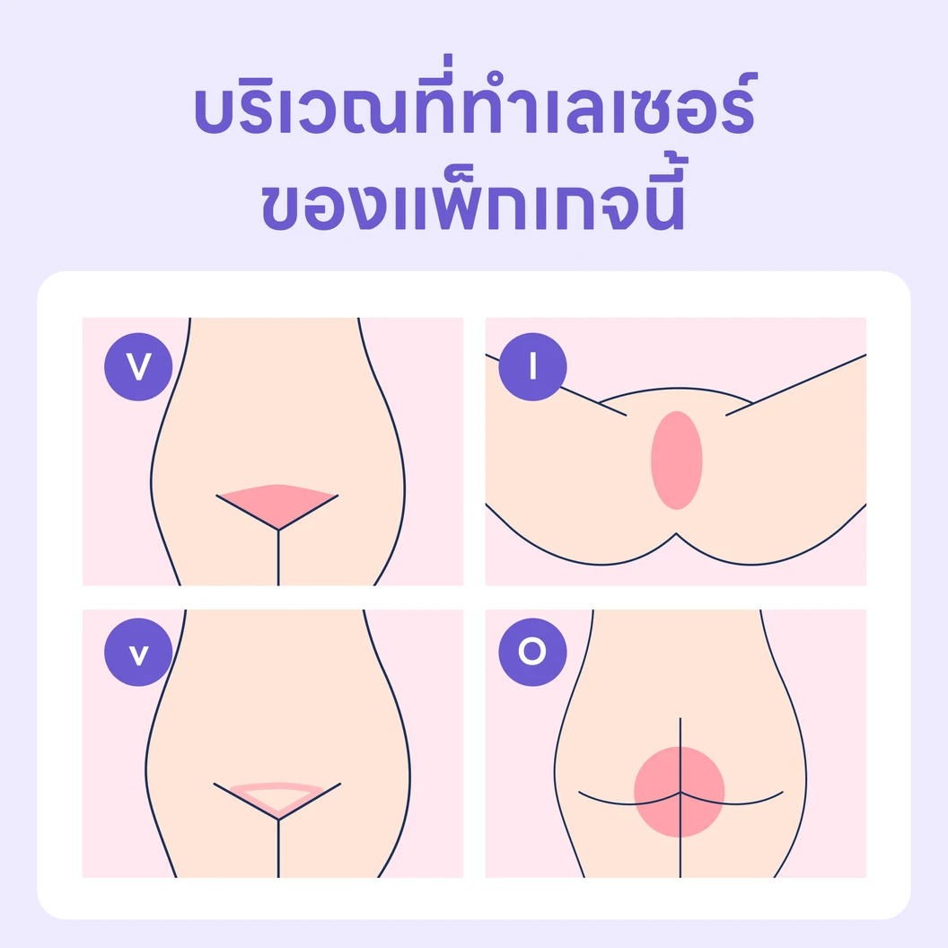 โปรแกรมกำจัดขน Brazilian ด้วย IPL 1 ครั้ง ฟรี! 1 ครั้ง สำหรับผู้หญิงเท่านั้น