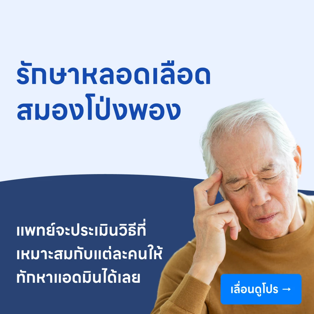 รักษาหลอดเลือดสมองโป่งพอง ด้วยการใส่ขดลวดหรือกาวอุดหลอดเลือด