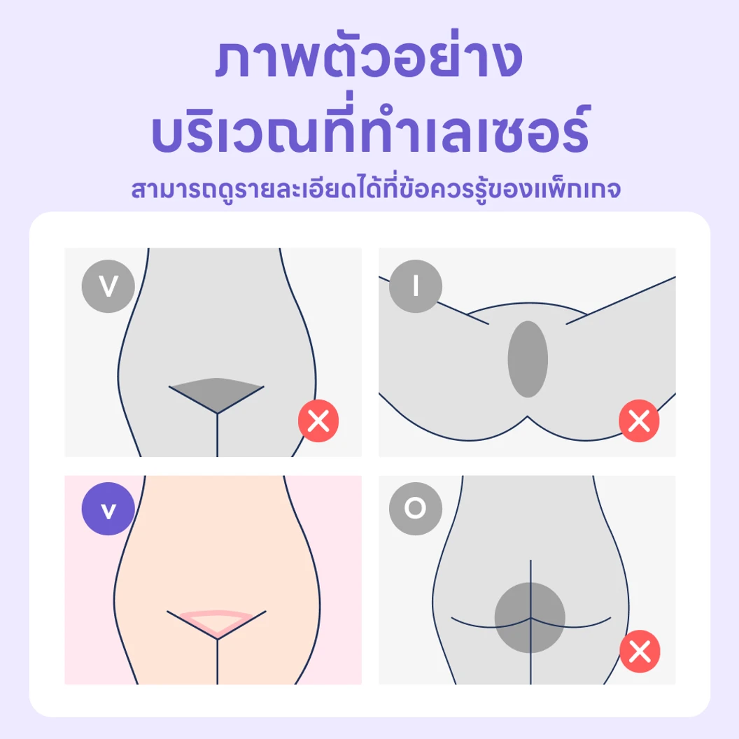 กำจัดขน Bikini ด้วย Diode Laser 1 ครั้ง สำหรับผู้หญิงหรือผู้ชาย