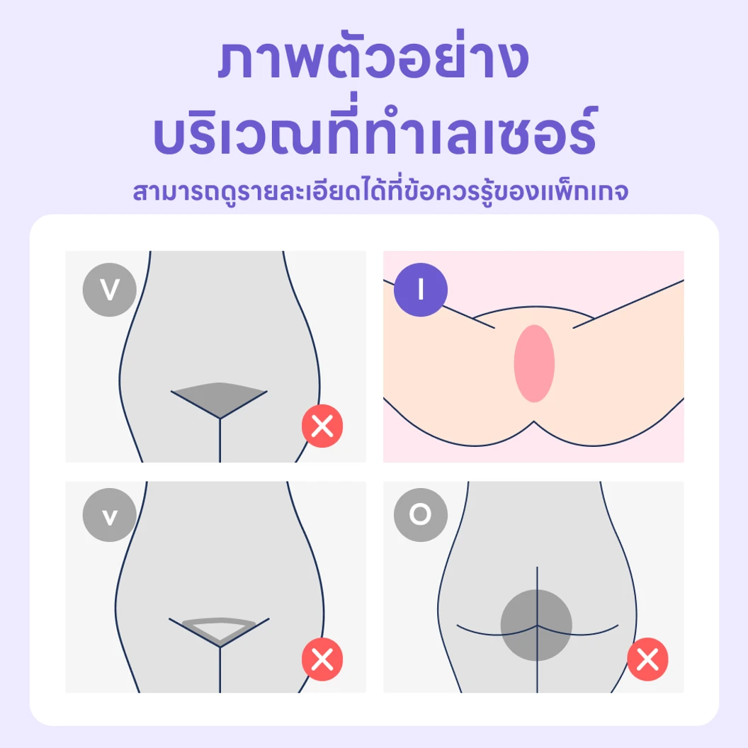 คอร์สกำจัดขน Brazilian ด้วย Diode Laser 10 ครั้ง ภายใน 1 ปี สำหรับผู้หญิงหรือผู้ชาย