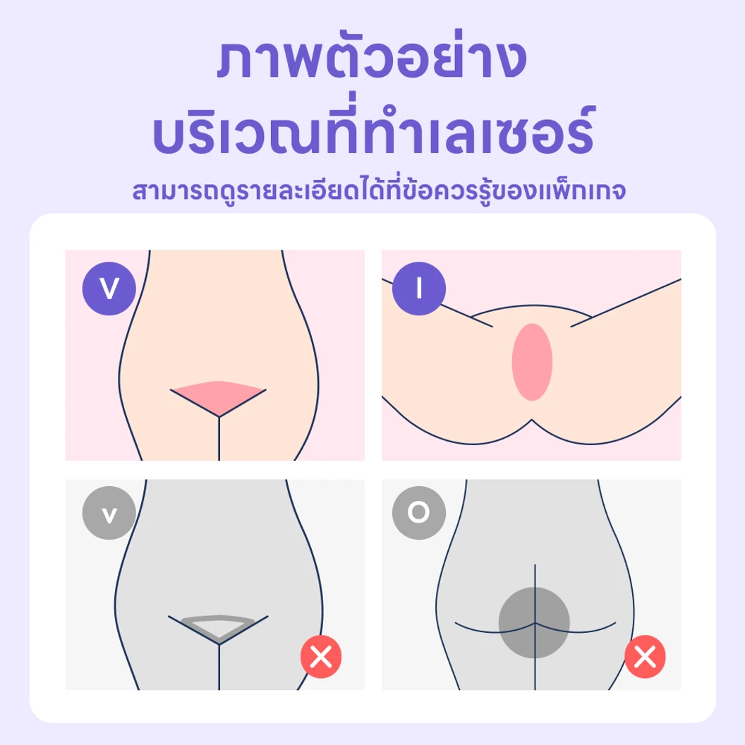 คอร์สกำจัดขน Brazilian ด้วย IPL 5 ครั้ง ภายใน 1 ปี สำหรับผู้หญิงเท่านั้น