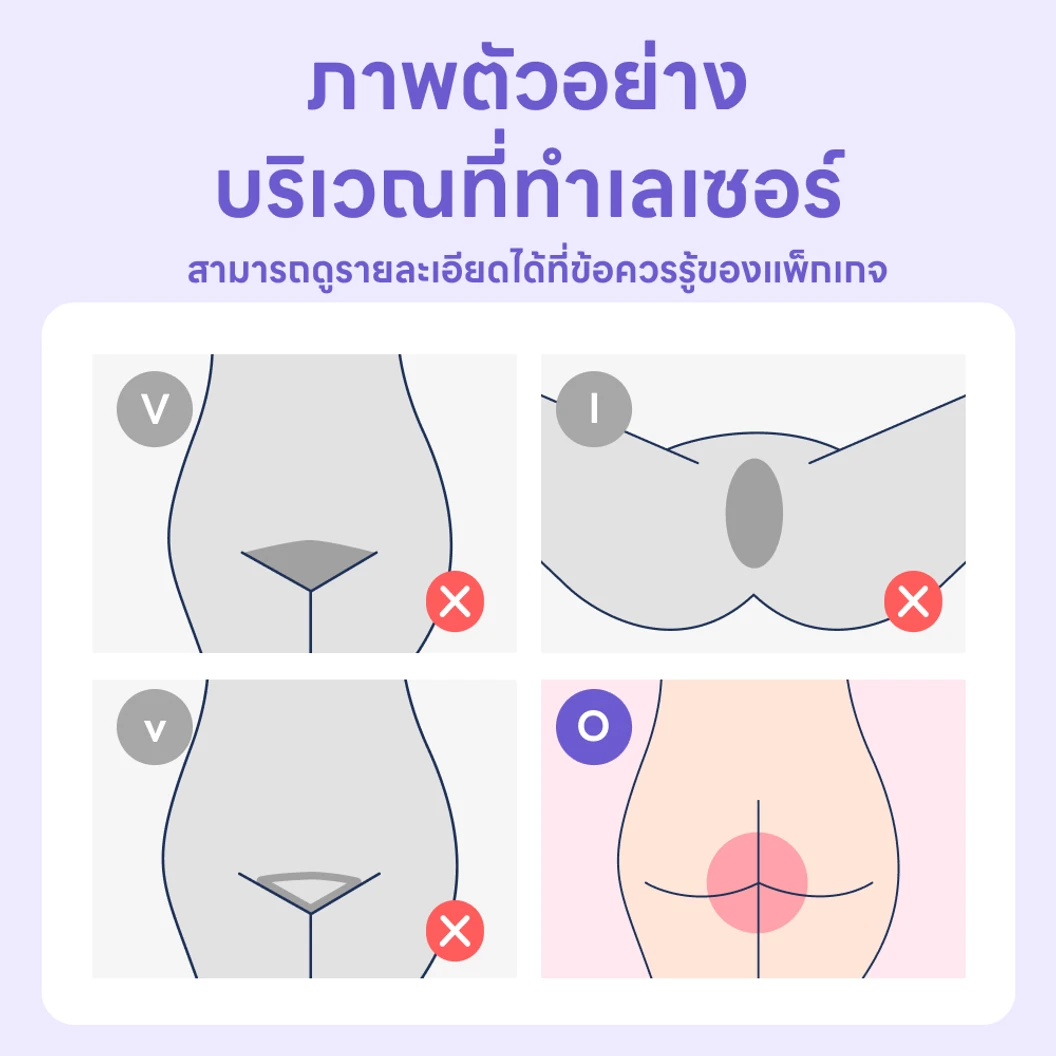 กำจัดขนบริเวณรอบรูทวารหนัก (O Line) ด้วยเลเซอร์ Trio Diode 1 ครั้ง สำหรับผู้หญิงหรือผู้ชาย