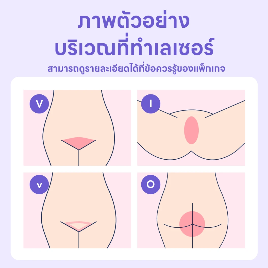 กำจัดขน Full Brazilian ด้วย Pro-YAG Laser 1 ครั้ง สำหรับผู้หญิงหรือผู้ชาย