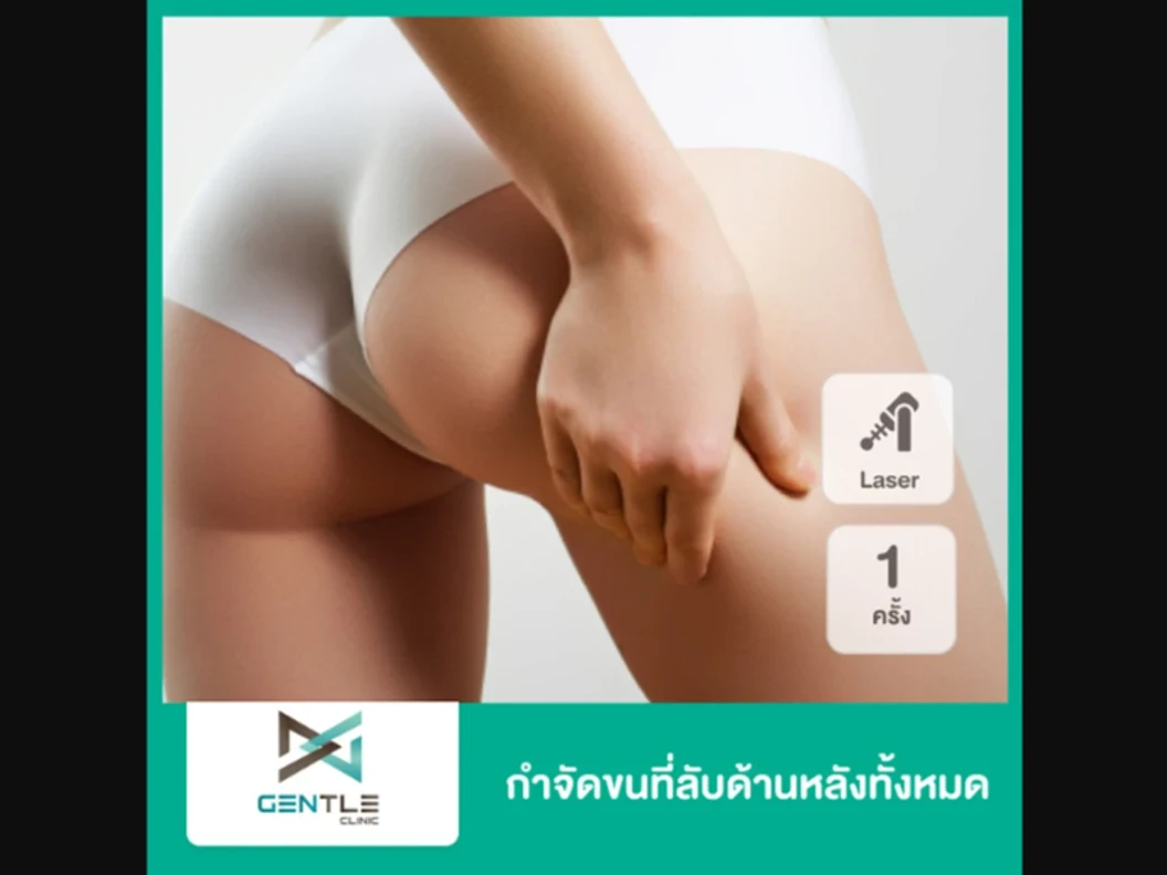 กำจัดขนบริเวณรอบรูทวารหนัก (O Line) ด้วยเลเซอร์ Trio Diode 1 ครั้ง สำหรับผู้หญิงหรือผู้ชาย