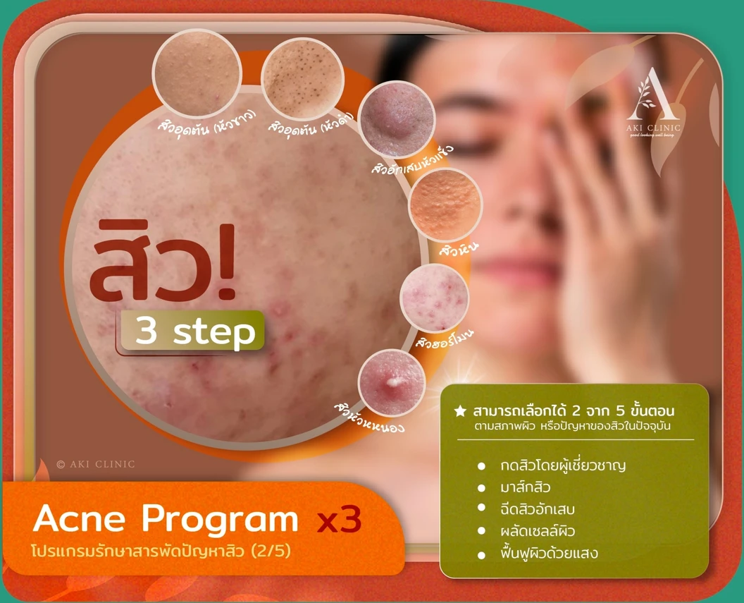 Acne Program โปรแกรมรักษาสิว 2 ขั้นตอน 1 ครั้ง