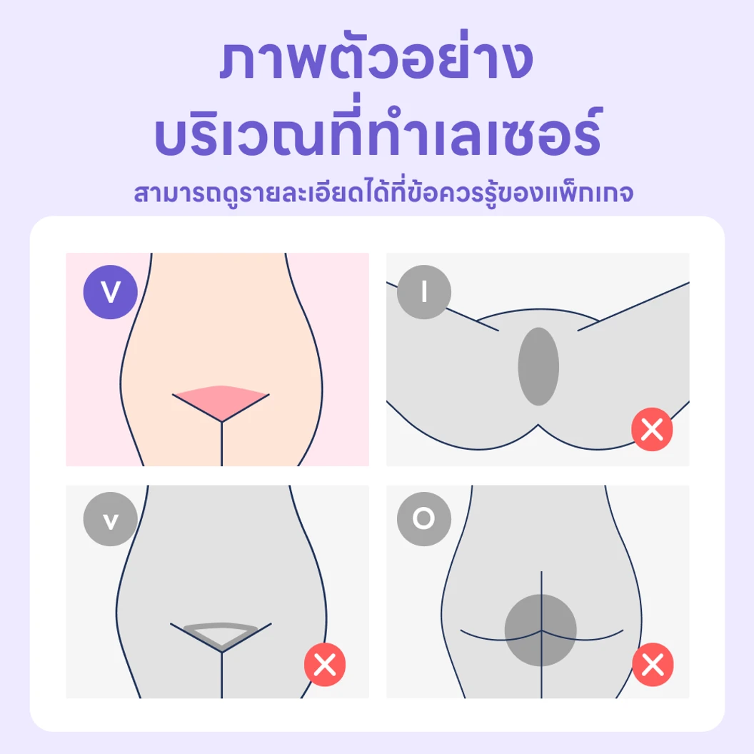 กำจัดขน Bikini Line ทั้งหมด ด้วย Diode Laser รุ่น Soprano ICE Platinum 1 ครั้ง สำหรับผู้หญิงหรือผู้ชาย
