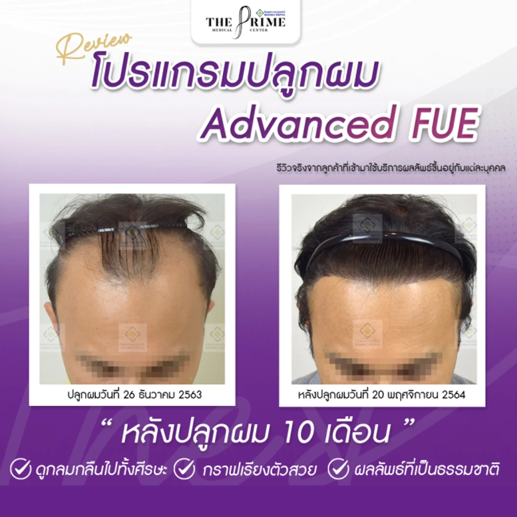 ปลูกผม ด้วยเทคนิค FUE Advance ไม่เกิน 2,000 กราฟต์ สำหรับเคสรีวิวเท่านั้น