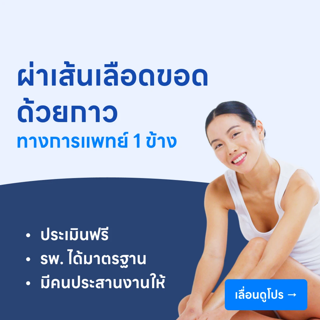 ผ่าตัดเส้นเลือดขอดด้วยกาวทางการแพทย์ 1 ข้าง