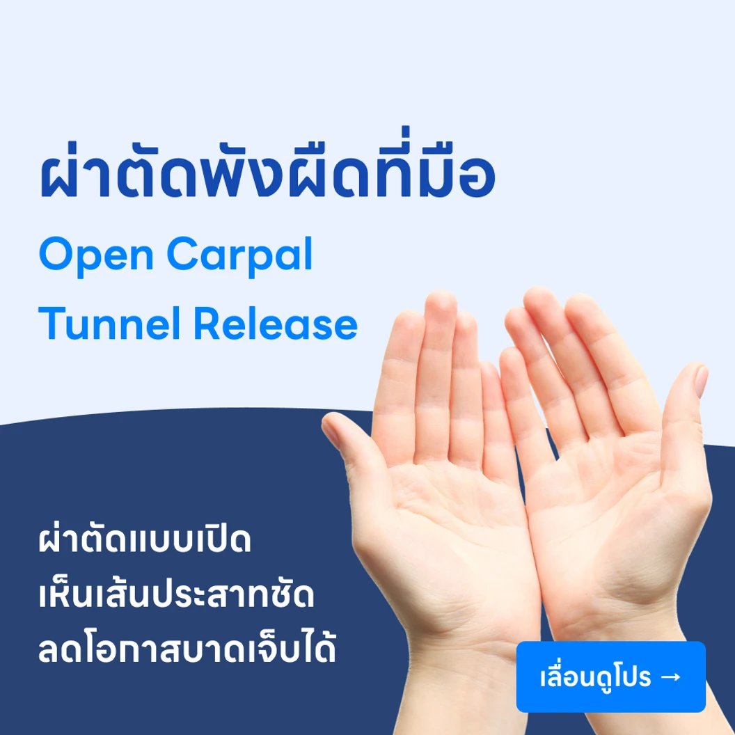ผ่าตัดพังผืดที่มือ (Open Carpal Tunnel Release)
