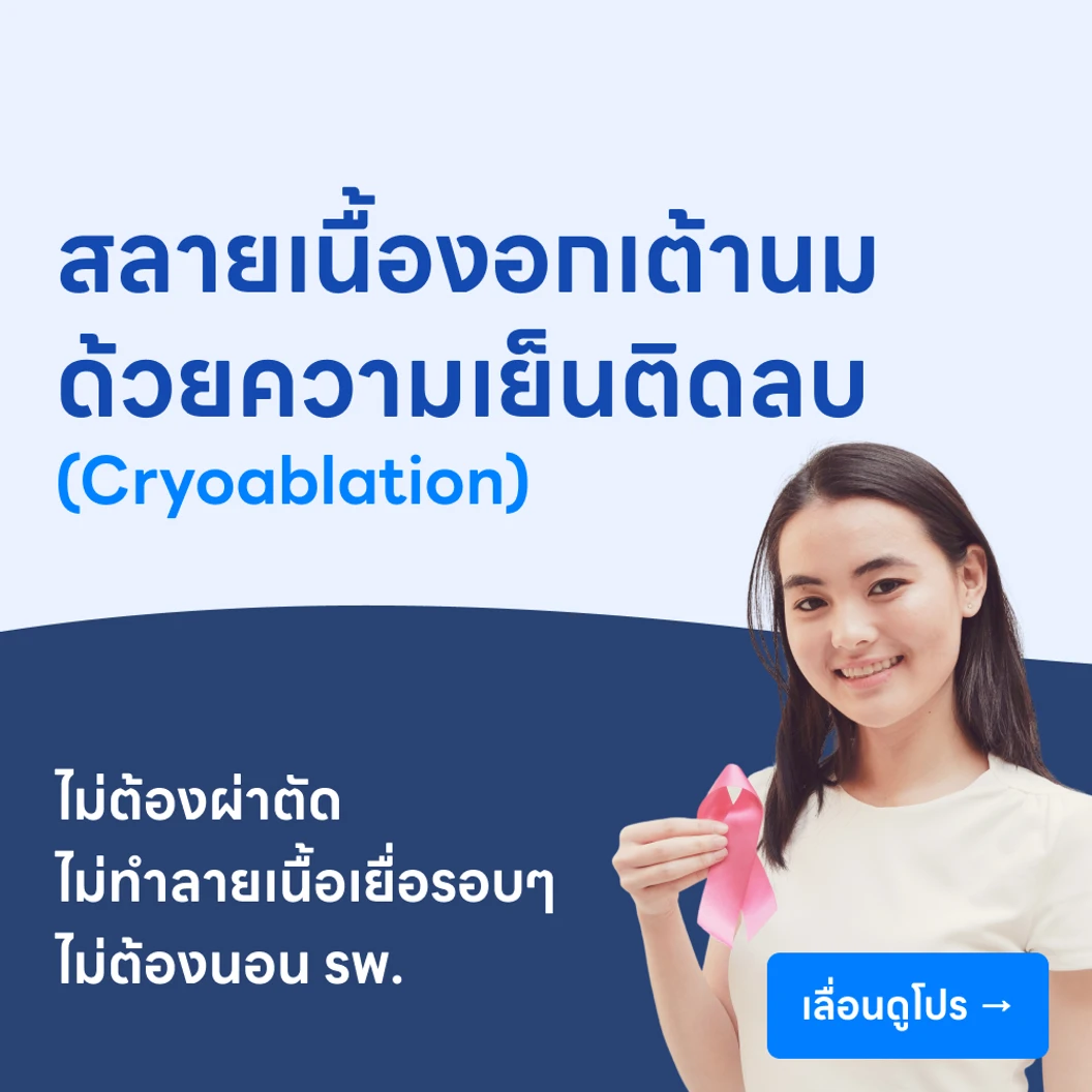 สลายเนื้องอกเต้านมด้วยความเย็นติดลบ (Cryoablation)