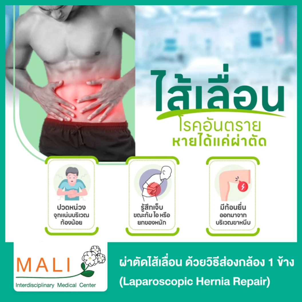ผ่าตัดไส้เลื่อน ด้วยวิธีส่องกล้อง 1 ข้าง (Laparoscopic Hernia Repair) นอนพักที่ รพ. 3 วัน 2 คืน