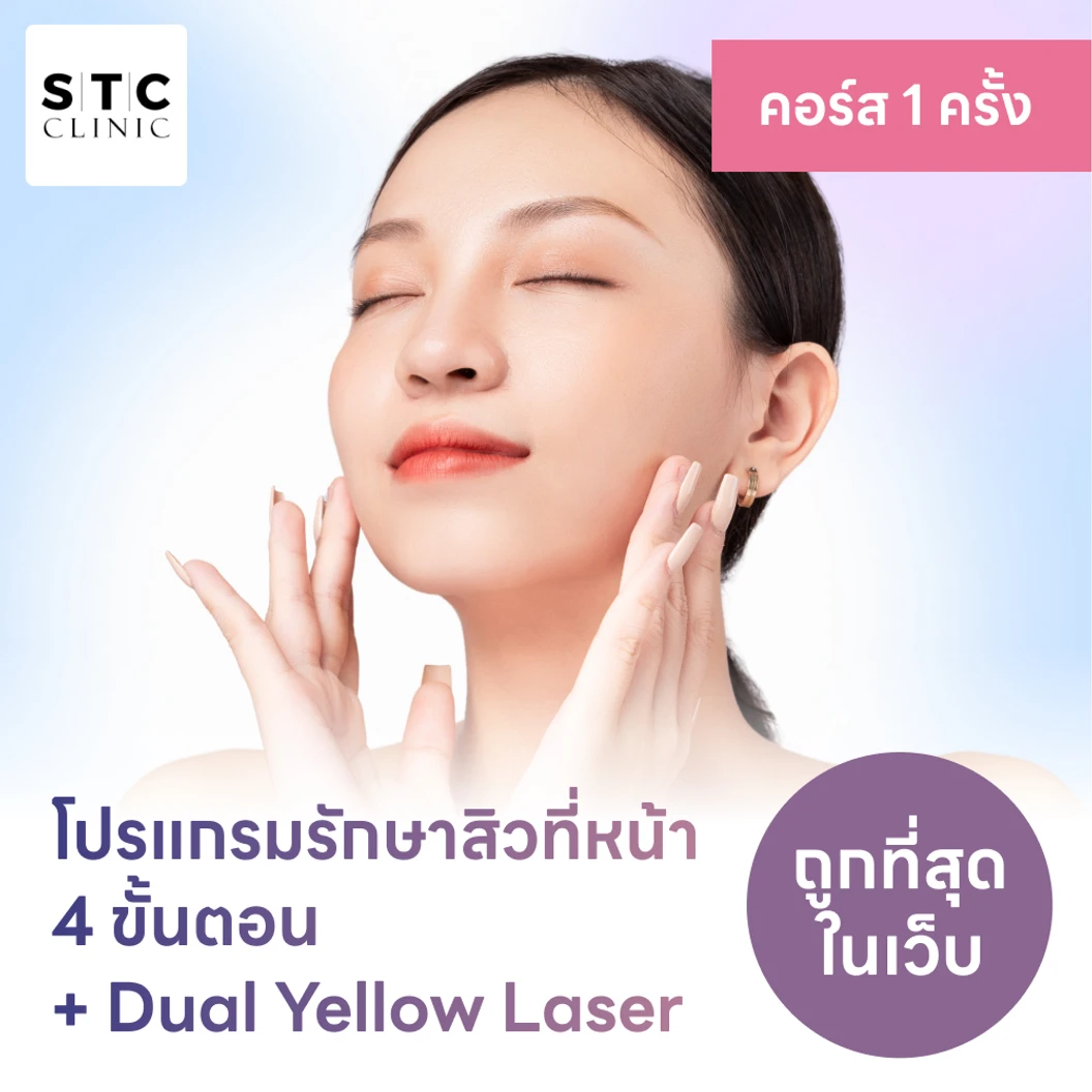 โปรแกรมรักษาสิวทั่วใบหน้า 4 ขั้นตอน รวมเลเซอร์ Dual Yellow ทั่วใบหน้า
