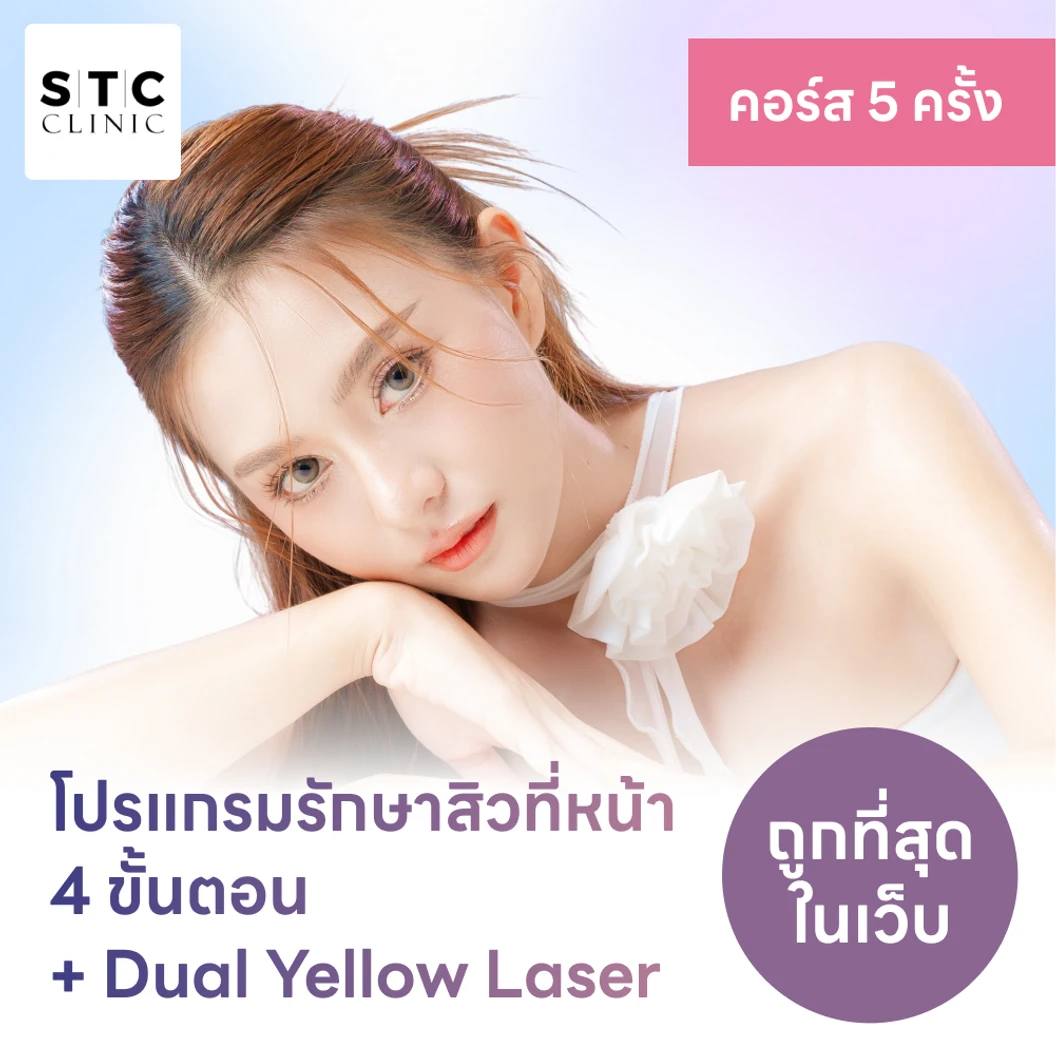 โปรแกรมรักษาสิวทั่วใบหน้า 4 ขั้นตอน รวมเลเซอร์ Dual Yellow ทั่วใบหน้า 4 ครั้ง ฟรี! 1 ครั้ง