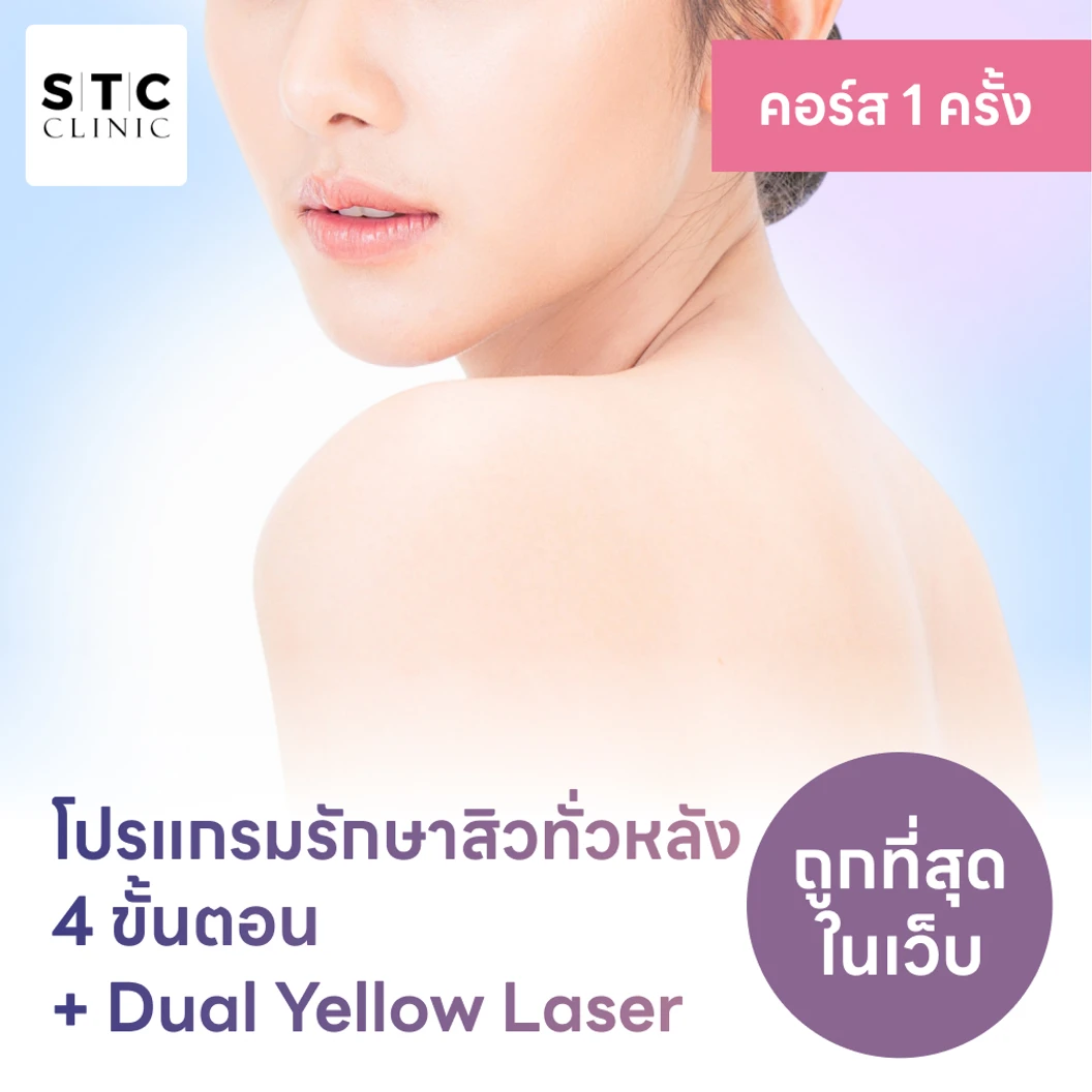 โปรแกรมรักษาสิวทั่วหลัง 4 ขั้นตอน รวมเลเซอร์ Dual Yellow ทั่วใบหน้า