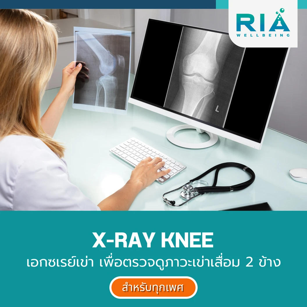 เอกซเรย์เข่า เพื่อตรวจดูภาวะเข่าเสื่อม 2 ข้าง