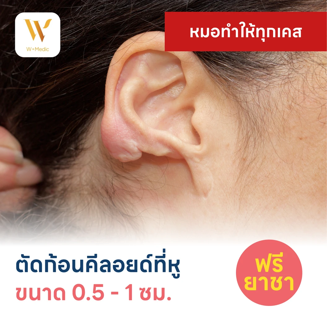 ตัดก้อนคีลอยด์ที่หู ขนาดเส้นผ่านศูนย์กลาง 0.5-1 ซม. 1 จุด 1 ครั้ง