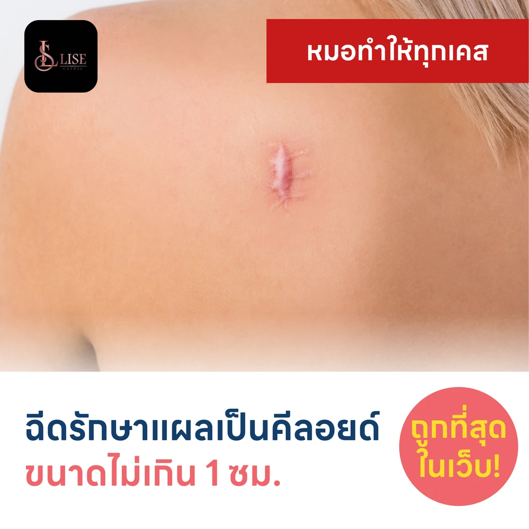 ฉีดรักษาแผลเป็นคีลอยด์ ขนาดเส้นผ่านศูนย์กลางไม่เกิน 1 ซม. 1 จุด 1 ครั้ง