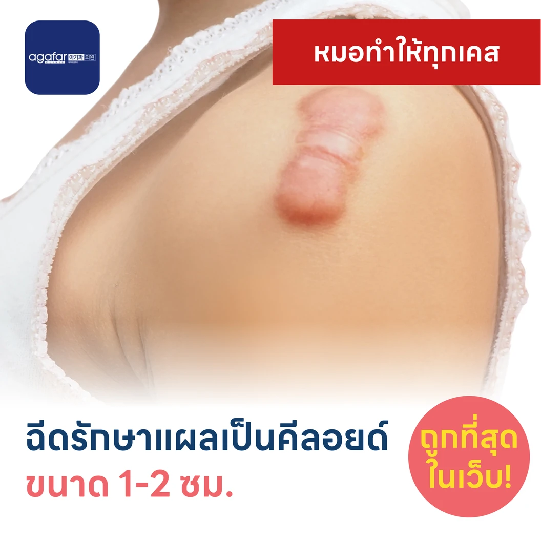 ฉีดรักษาแผลเป็นคีลอยด์ ขนาดเส้นผ่านศูนย์กลาง 1-2 ซม. 1 จุด 1 ครั้ง