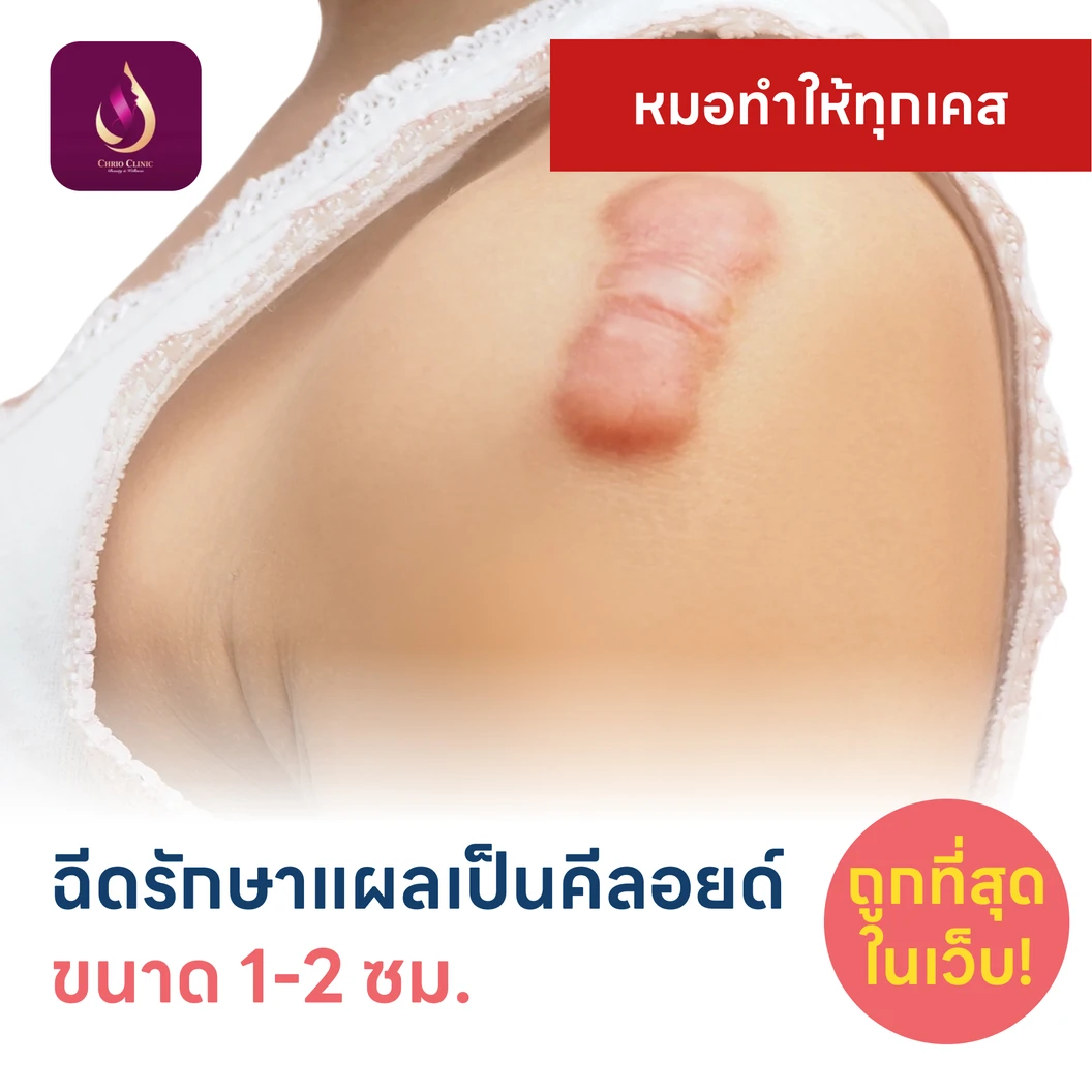 ฉีดรักษาแผลเป็นคีลอยด์ ขนาดเส้นผ่านศูนย์กลาง 1-2 ซม. 1 จุด 1 ครั้ง