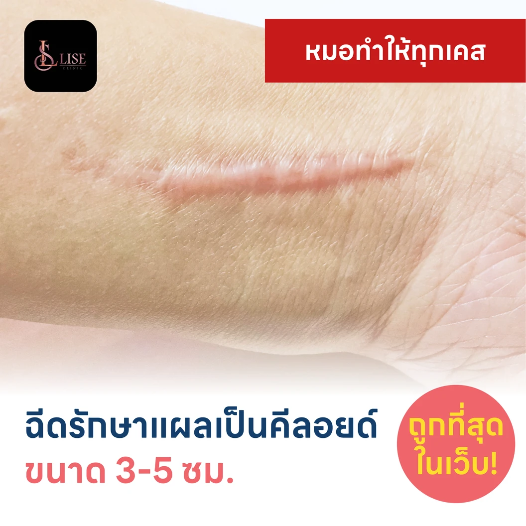 ฉีดรักษาแผลเป็นคีลอยด์ ขนาดเส้นผ่านศูนย์กลาง 3-5 ซม. 1 จุด 1 ครั้ง