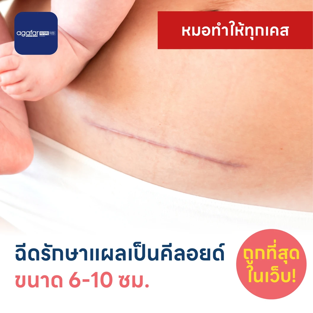 ฉีดรักษาแผลเป็นคีลอยด์ ขนาดเส้นผ่านศูนย์กลาง 6-10 ซม. 1 จุด 1 ครั้ง
