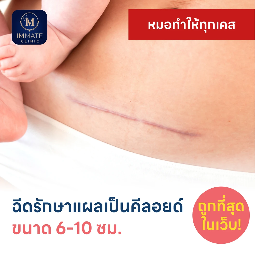ฉีดรักษาแผลเป็นคีลอยด์ ขนาดเส้นผ่านศูนย์กลาง 6-10 ซม. 1 จุด 1 ครั้ง