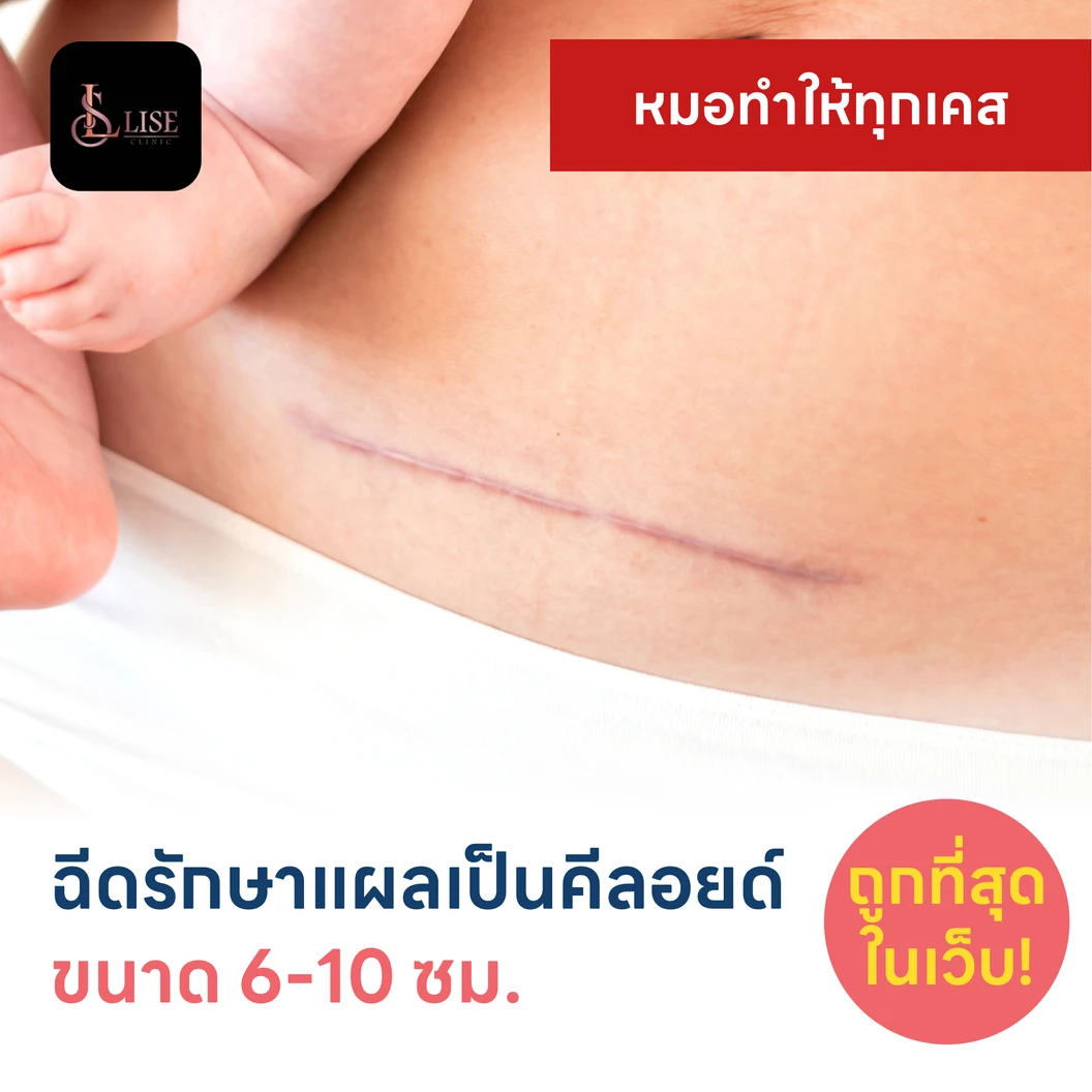 ฉีดรักษาแผลเป็นคีลอยด์ ขนาดเส้นผ่านศูนย์กลาง 6-10 ซม. 1 จุด 1 ครั้ง