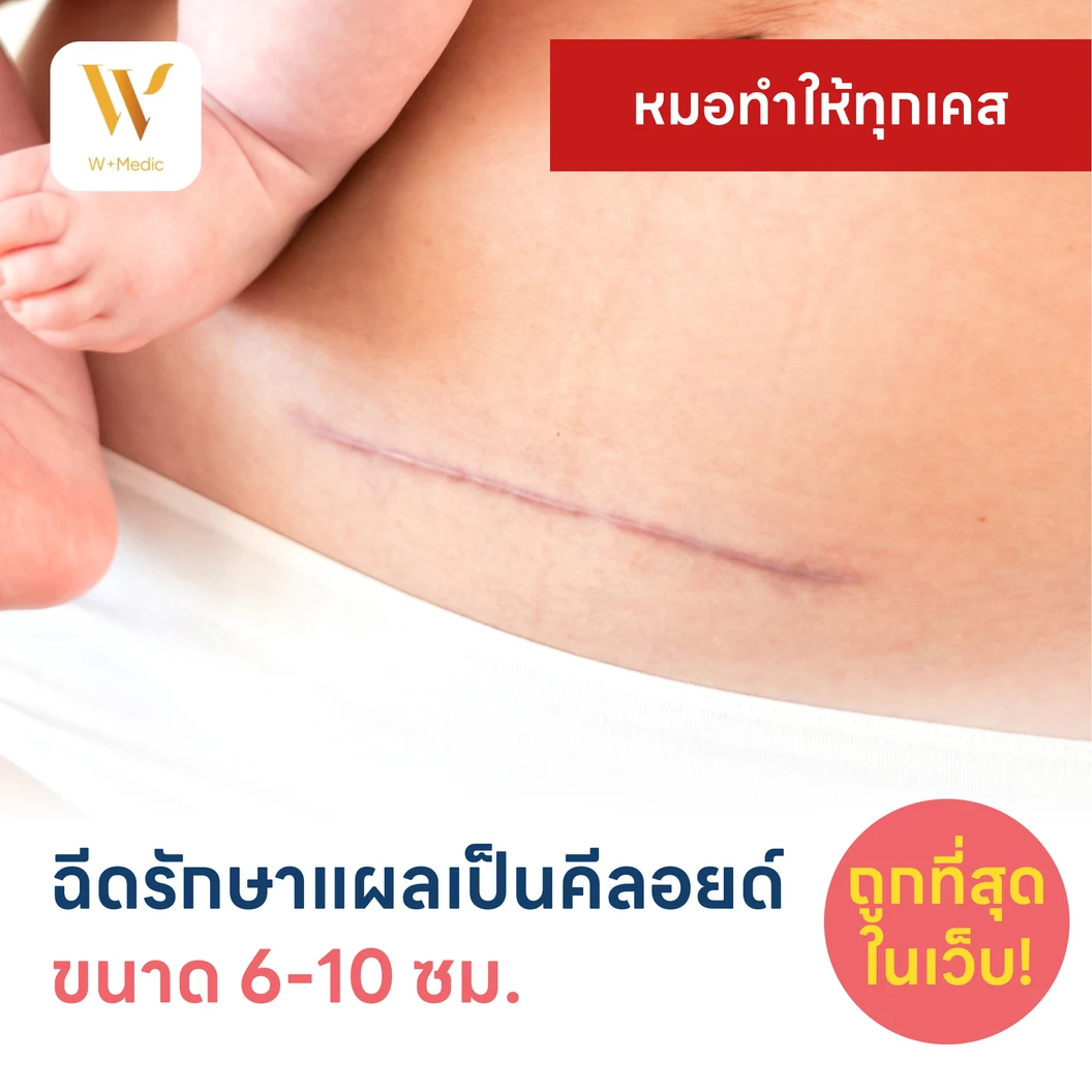 ฉีดรักษาแผลเป็นคีลอยด์ ขนาดเส้นผ่านศูนย์กลาง 6-10 ซม. 1 จุด 1 ครั้ง