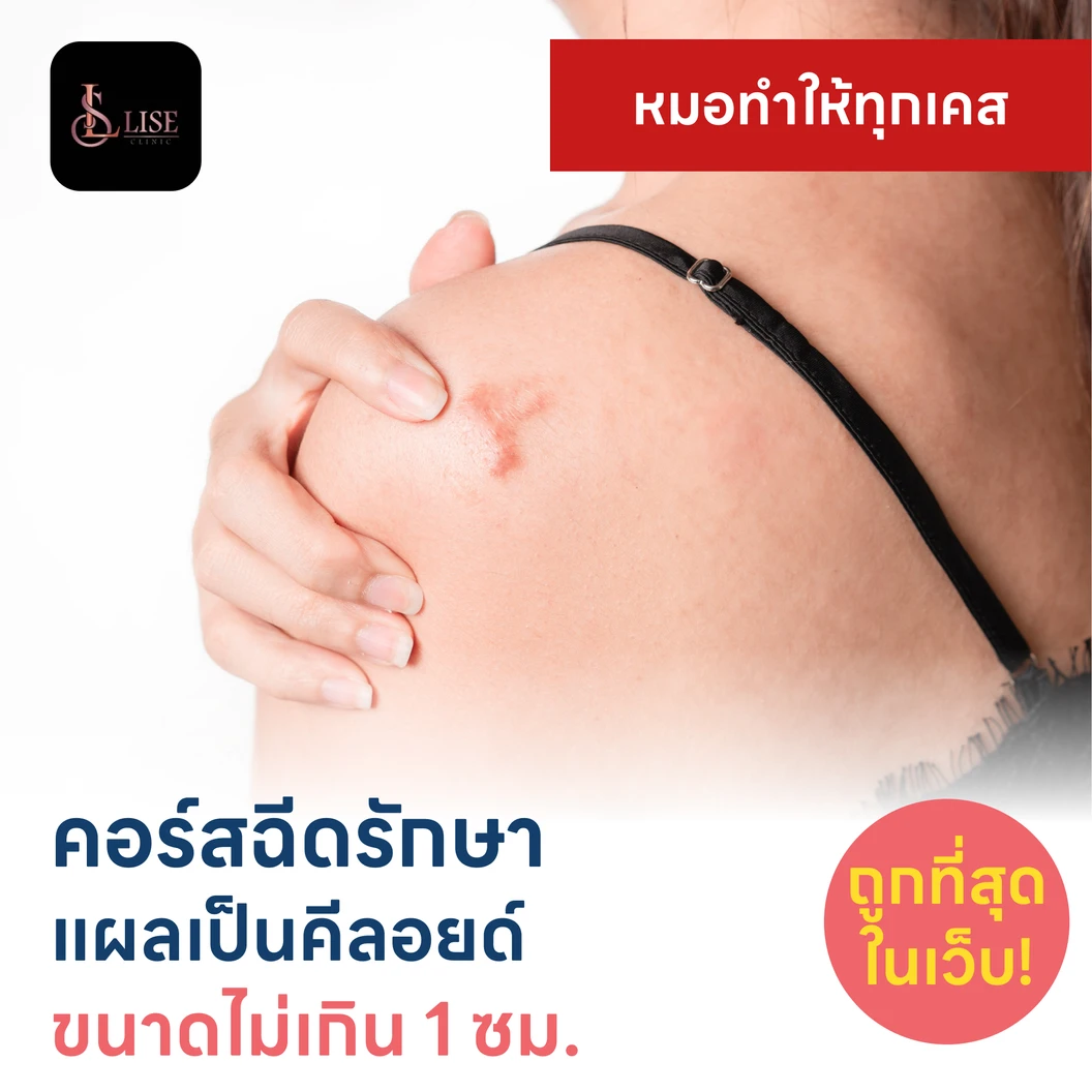 คอร์สฉีดรักษาแผลเป็นคีลอยด์ ขนาดเส้นผ่านศูนย์กลางไม่เกิน 1 ซม. 1 จุด 5 ครั้ง