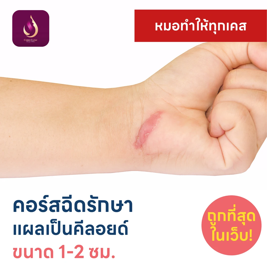 คอร์สฉีดรักษาแผลเป็นคีลอยด์ ขนาดเส้นผ่านศูนย์กลาง 1-2 ซม. 1 จุด 5 ครั้ง