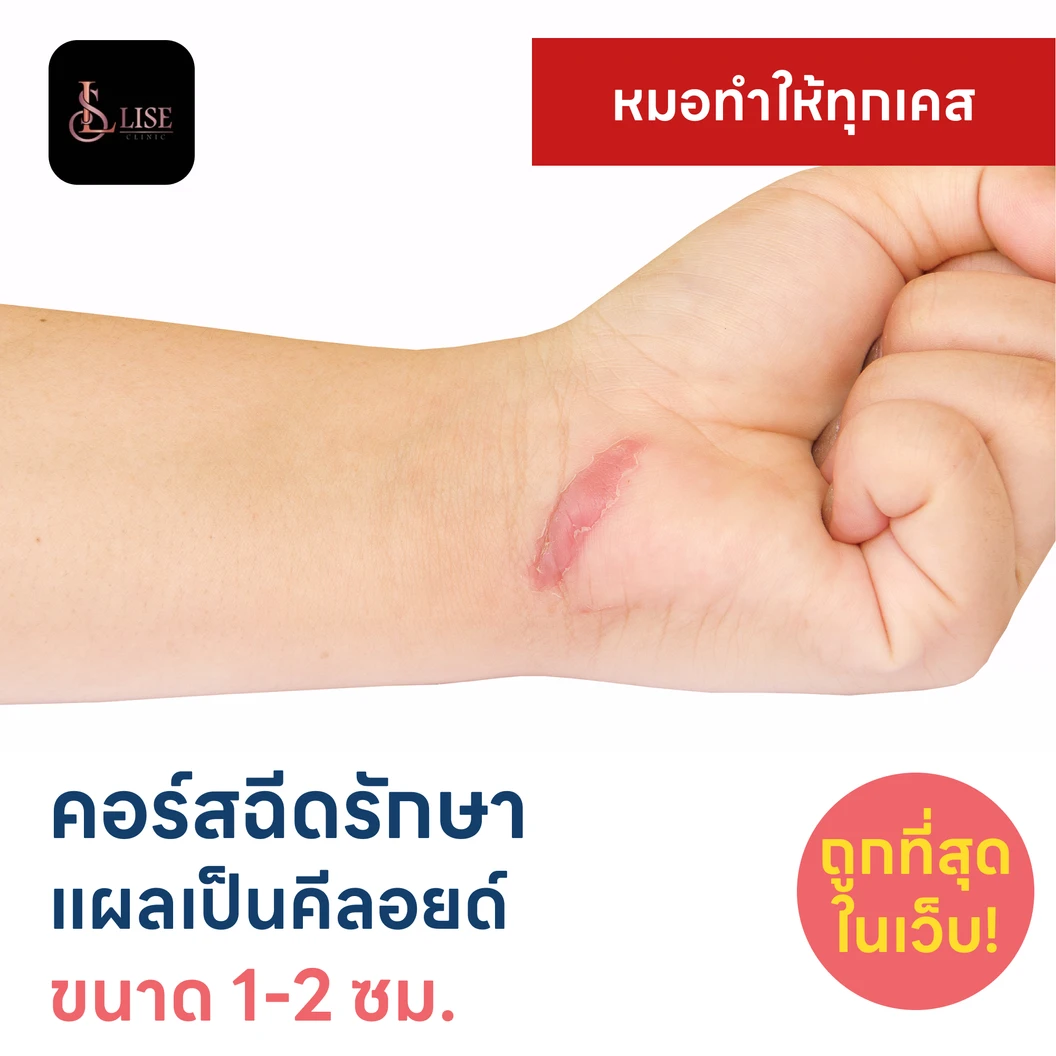 คอร์สฉีดรักษาแผลเป็นคีลอยด์ ขนาดเส้นผ่านศูนย์กลาง 1-2 ซม. 1 จุด 5 ครั้ง