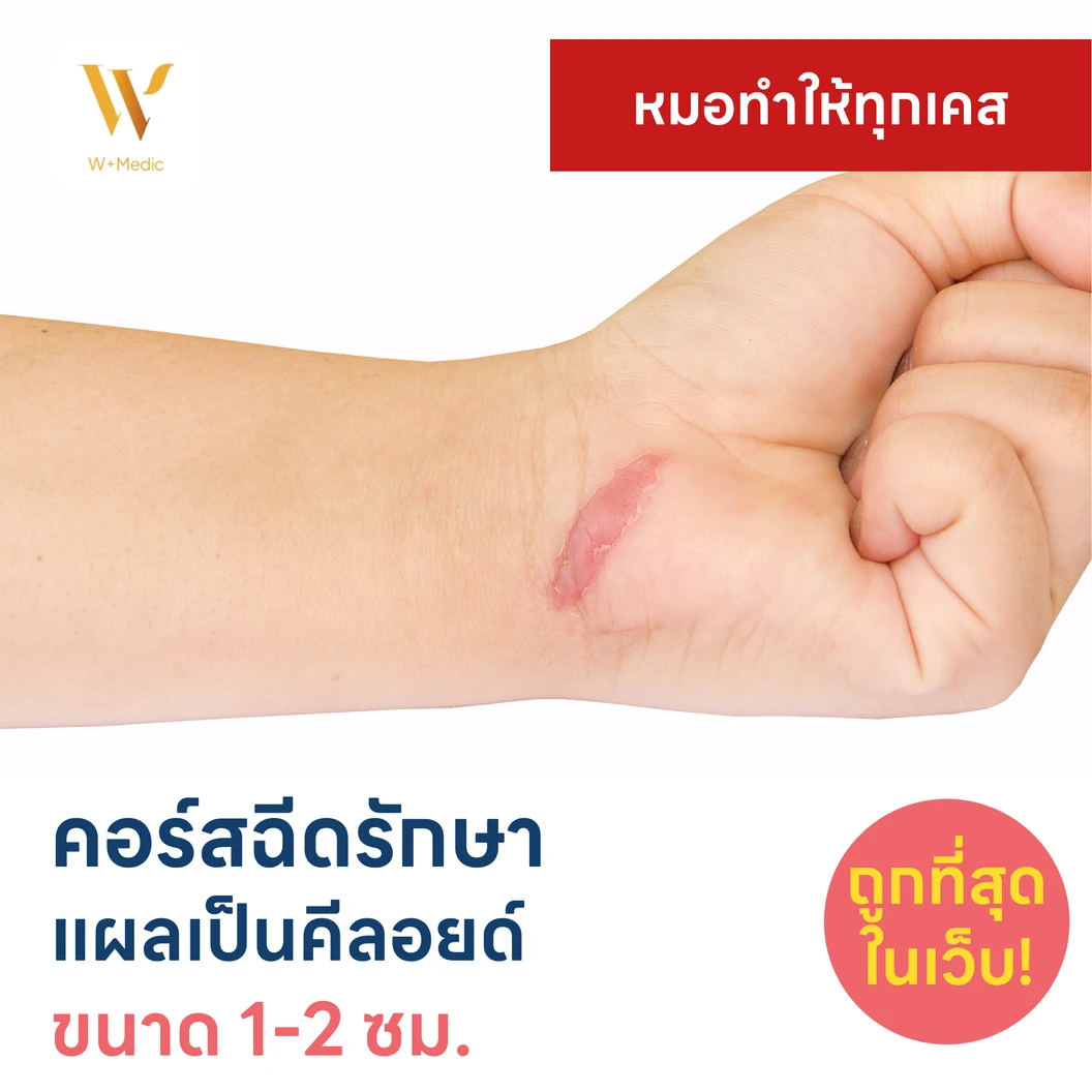 คอร์สฉีดรักษาแผลเป็นคีลอยด์ ขนาดเส้นผ่านศูนย์กลาง 1-2 ซม. 1 จุด 5 ครั้ง