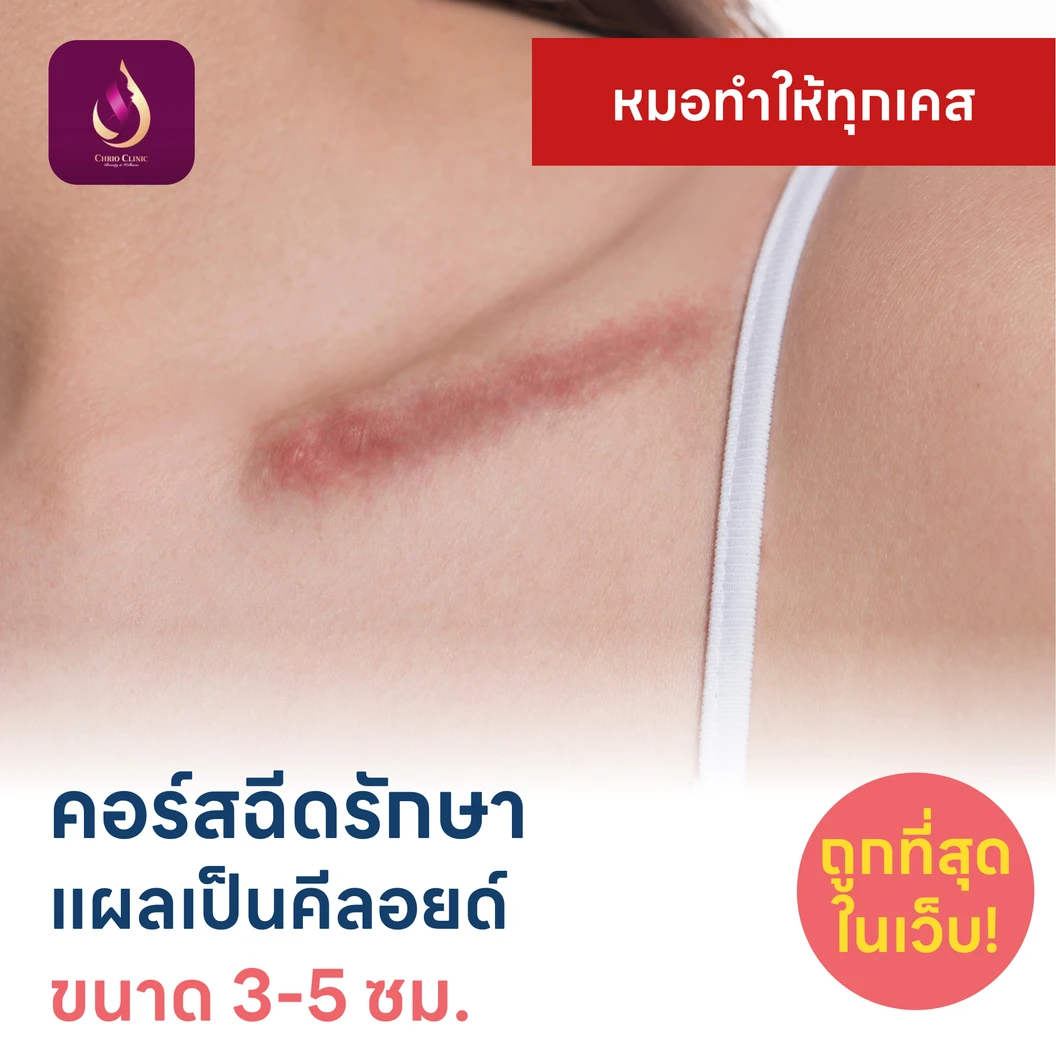 คอร์สฉีดรักษาแผลเป็นคีลอยด์ ขนาดเส้นผ่านศูนย์กลาง 3-5 ซม. 1 จุด 5 ครั้ง