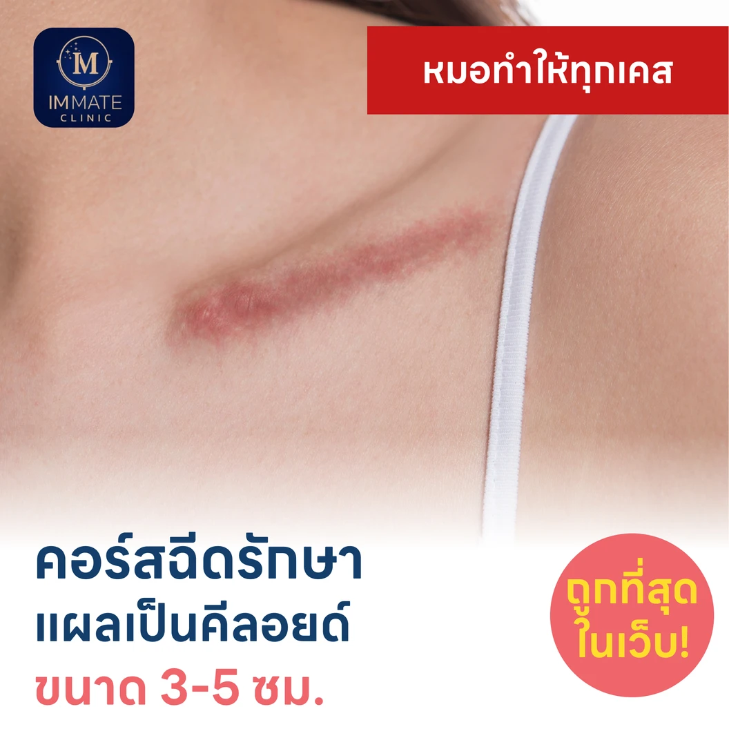 คอร์สฉีดรักษาแผลเป็นคีลอยด์ ขนาดเส้นผ่านศูนย์กลาง 3-5 ซม. 1 จุด 5 ครั้ง