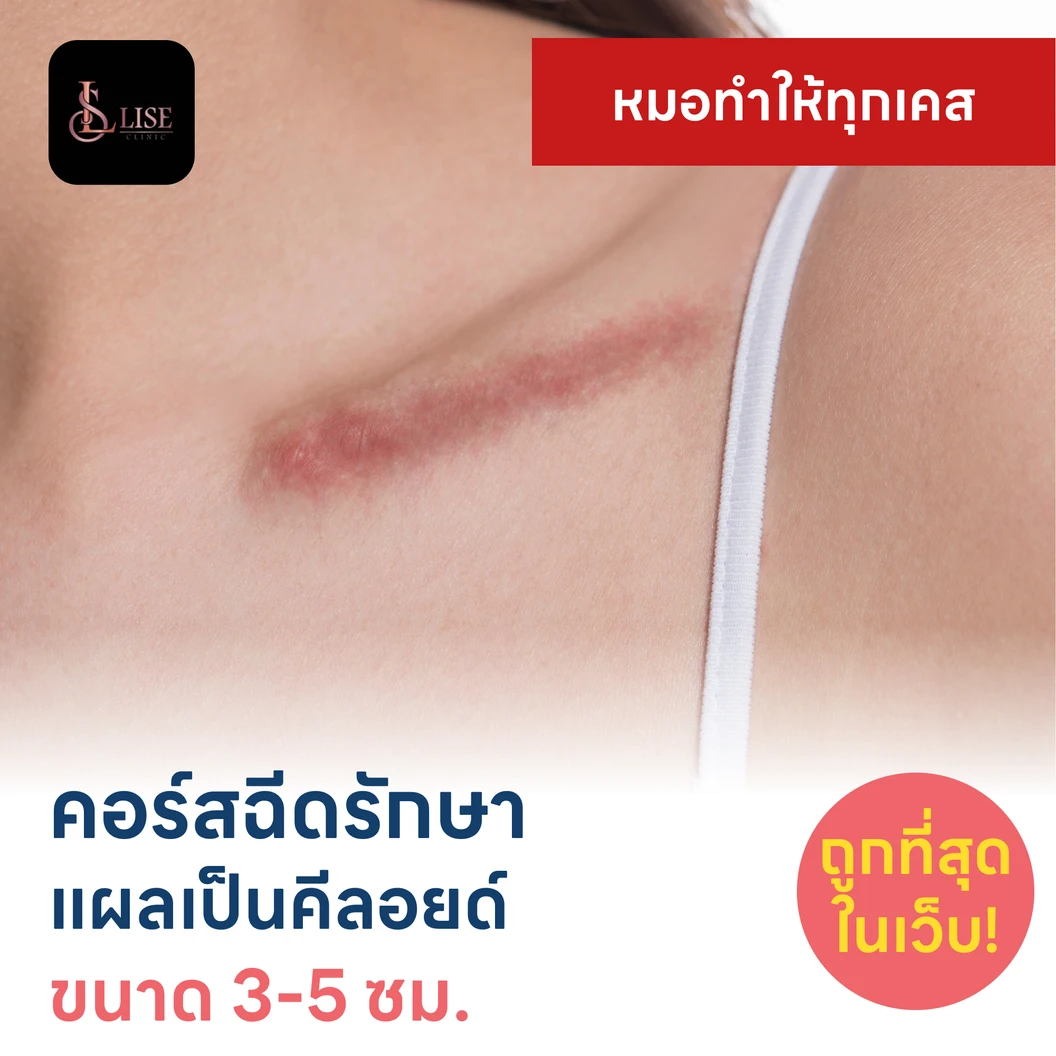คอร์สฉีดรักษาแผลเป็นคีลอยด์ ขนาดเส้นผ่านศูนย์กลาง 3-5 ซม. 1 จุด 5 ครั้ง