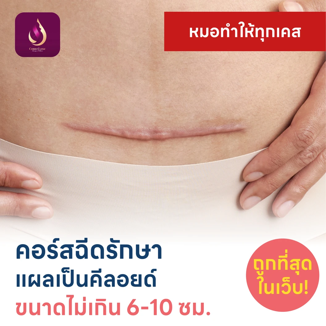 คอร์สฉีดรักษาแผลเป็นคีลอยด์ ขนาดเส้นผ่านศูนย์กลาง 6-10 ซม. 1 จุด 5 ครั้ง