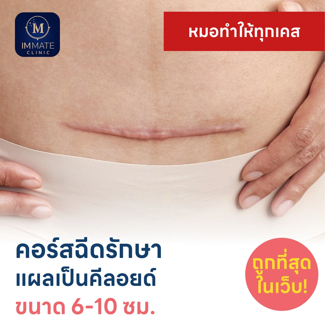 คอร์สฉีดรักษาแผลเป็นคีลอยด์ ขนาดเส้นผ่านศูนย์กลาง 6-10 ซม. 1 จุด 5 ครั้ง