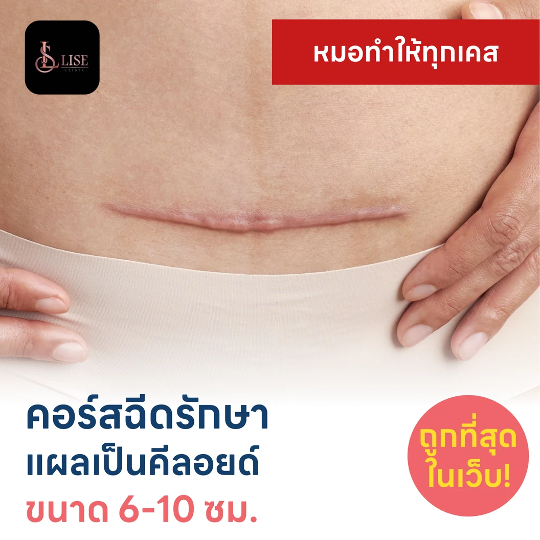 คอร์สฉีดรักษาแผลเป็นคีลอยด์ ขนาดเส้นผ่านศูนย์กลาง 6-10 ซม. 1 จุด 5 ครั้ง