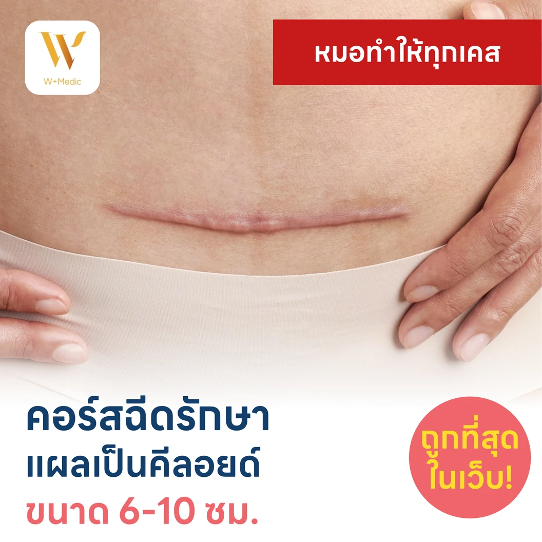 คอร์สฉีดรักษาแผลเป็นคีลอยด์ ขนาดเส้นผ่านศูนย์กลาง 6-10 ซม. 1 จุด 5 ครั้ง