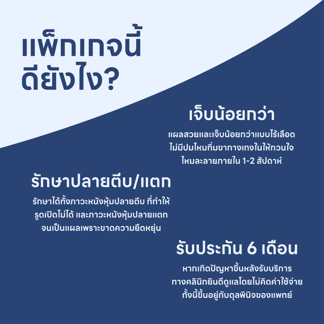 ขริบหนังหุ้มปลาย Laser Sleeve Technique แบบไร้ปมไหม