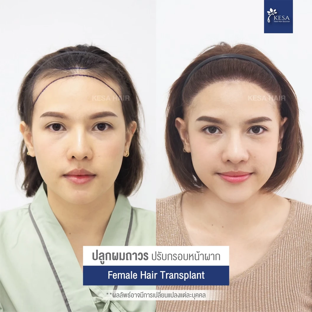 ปลูกผมถาวร ด้วยเทคนิค NNN 2025 จำนวน 3,001-4,000 กราฟต์ 1 ครั้ง