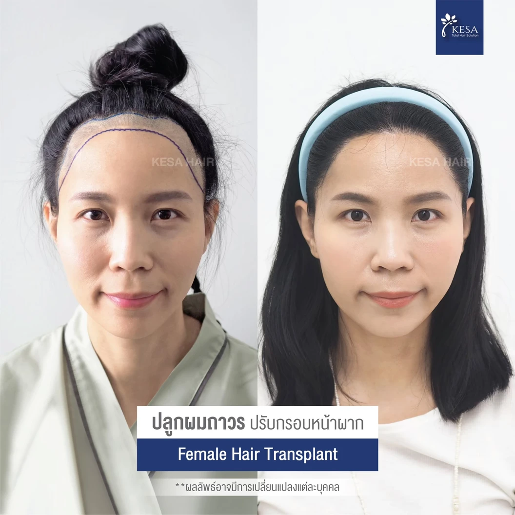 ปลูกผมถาวร ด้วยเทคนิค NNN 2025 จำนวน 3,001-4,000 กราฟต์ 1 ครั้ง